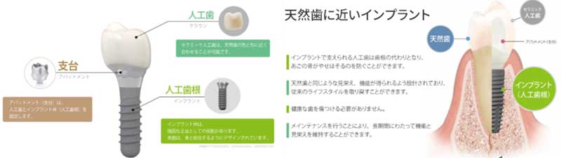 デンタルインプラント