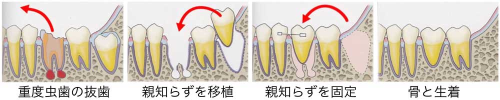 自家歯牙移植